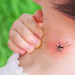 蚊に刺されてもかゆくならない方法に関する雑学